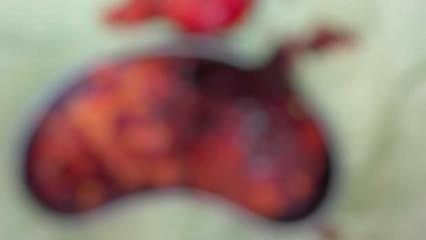 Şişkinlik şikayetiyle başvurdu, karnından 2 kilo 200 gram t&uuml;m&ouml;r &ccedil;ıktı