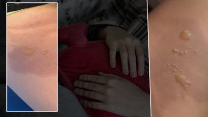 Yine sıcak su torbası yine facia: 3 dakika sonra patladı!