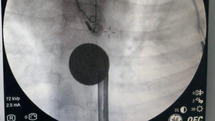 G&ouml;ren inanamadı! 8 yaşındaki &ccedil;ocuğun boğazından &ccedil;ıkartılan şaşırttı