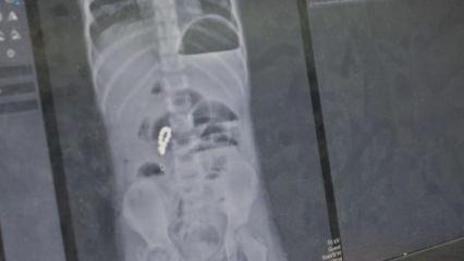 K&uuml;&ccedil;&uuml;k kızın bağırsağından &ccedil;ıkanlar şoke etti! &Ccedil;ocuklardan uzak tutun uyarısı