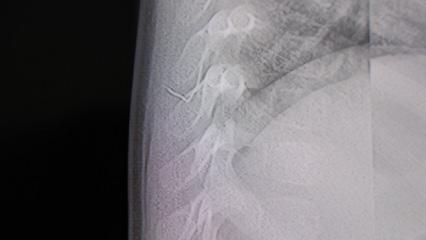 Sırt &uuml;st&uuml; yatınca ağlıyordu! 1 yaşındaki bebeğin v&uuml;cudundan &ccedil;ıkan cisim şoke etti