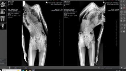 Mersin'de &ouml;nemli başarı: 18 yaşındaki gencin boyu ameliyatla 4 santimetre uzadı