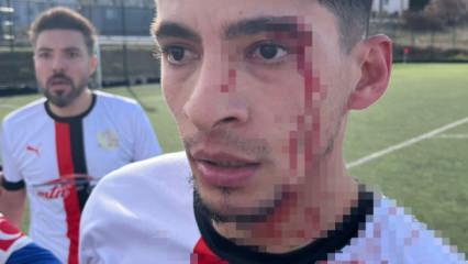 Yeşil sahada kan g&ouml;vdeyi g&ouml;t&uuml;rd&uuml;: 3 futbolcu hastanelik oldu