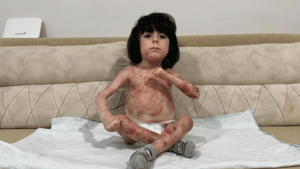 4 yaşındaki İbrahim'in ailesinden y&uuml;rek yakan feryat! Hastalığı y&uuml;z&uuml;nden kıyafet giyemiyor