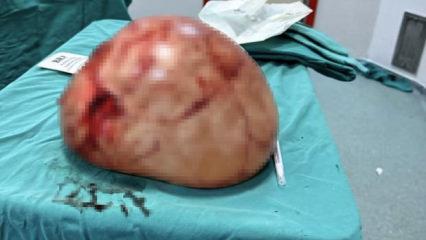 Van'da tıp d&uuml;nyasını şaşırtan operasyon: Karnından 35 santimetrelik kitle &ccedil;ıktı