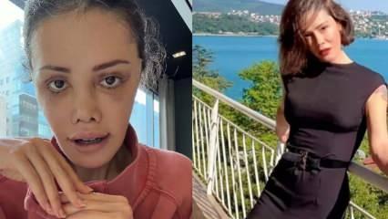 Y&uuml;z nakli sonrası kaşında sa&ccedil; &ccedil;ıktı! Didem Ceran'dan şaşırtan paylaşım