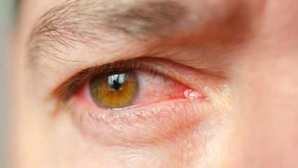 T&uuml;rkiye&rsquo;de 2 milyon kişi risk altında! Sessiz ilerliyor, kalıcı k&ouml;rl&uuml;ğe neden olabiliyor