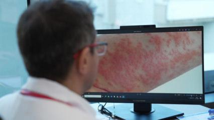 Uzmanından uyarı: Egzamalı &ccedil;ocuğa ezbere diyet yaptırmayın