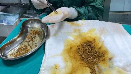 Karın ağrısı şikayetiyle gitti, v&uuml;cudundan 2 bin 67 tane taş &ccedil;ıktı