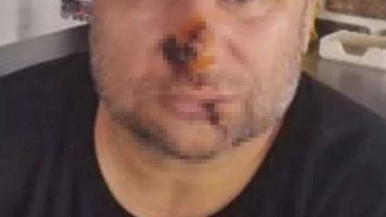 &Uuml;nl&uuml; şarkıcının y&uuml;z&uuml; &ccedil;&uuml;r&uuml;meye başladı! Ent&uuml;be edildi...