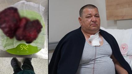 Bilecik'te ilgin&ccedil; vaka: Boynundaki 542 gramlık kitle &ccedil;ıkartıldı 