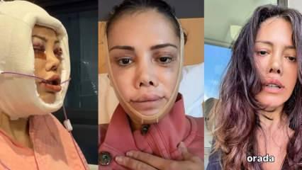 Y&uuml;z nakli ge&ccedil;iren Didem Ceran ateş p&uuml;sk&uuml;rd&uuml;: 'İnsanlar neden yaraya tuz basar?'