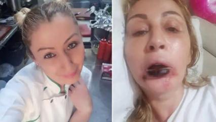 Yaptırdığı işlem sonrası dudağı &ccedil;&uuml;r&uuml;d&uuml;! 7 yıldır kabusu yaşıyor...