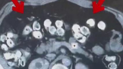 2 kilo 675 gram Afyon sakızı yuttuğu tespit edilen 3 ş&uuml;pheli tutuklandı