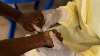 G&uuml;ney Afrika&rsquo;da son 5 haftada 13 kişide M &ccedil;i&ccedil;eği vakası kaydedildi