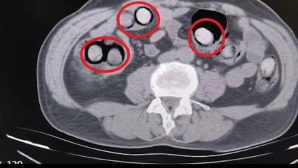 Midesinden &ccedil;ıkan şoke etti! 758 gram uyuşturucuyla yakalandı