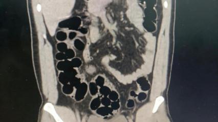 Midesinden kaps&uuml;ller i&ccedil;inde 943 gram eroin &ccedil;ıktı