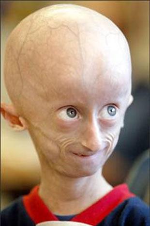 Progeria: 80 yaşındaki çocuk sendromu---Progeria'ya bir çocuğun genetik şifresindeki ufacık, basit bir kusur neden olabilir ama yıkıcı ve hayatını değiştiren sonuçlara yol açar.