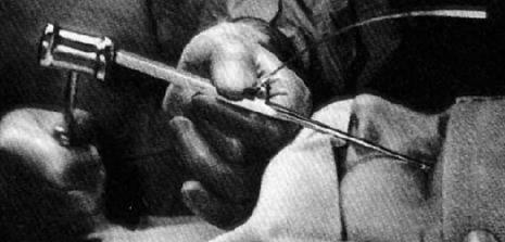 9-LOBOTOMİ:

Hastanın beyninin bir kısmını kesip çıkarmayı içeren bu ilginç yöntem, yıllarca şizofreni, klinik depresyon gibi birçok sinir hastalığını tedavi etmekte kullanıldı. Antipsikotik ilaçlar bulunduktan sonra bu yöntem bırakıldı ve bu yöntem tıp tarihindeki en yanlış tedavi yöntemlerinden biri olarak literatürde yerini aldı.