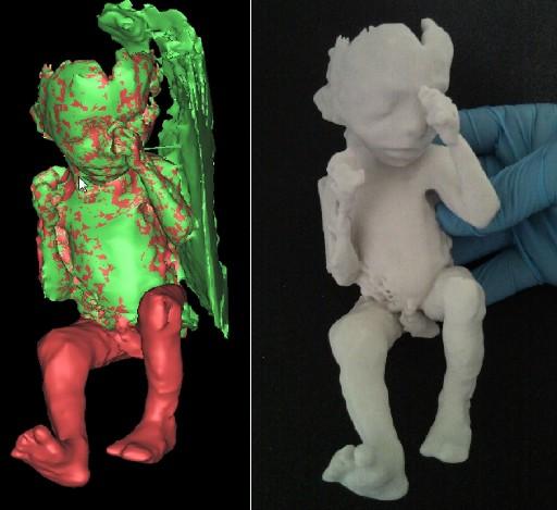 Yeni geliştirilen bir teknoloji ile fetüsün birebir ölçüde ve 3 boyutlu plastik modeli elde edilebiliyor.