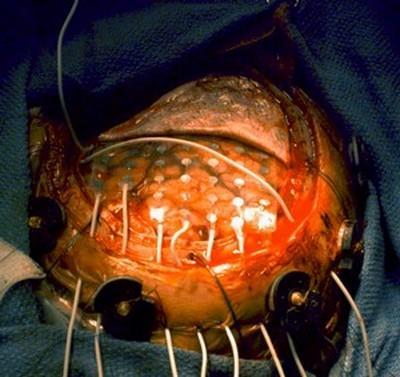 8-FELÇLİ BÖLGEYİ KİMYASAL OLARAK UYARMA:
Bu yöntemi ilk olarak Macar bir doktor uygulamıştı. Macar doktor, bazı hastaların felç olduktan sonra şizofrenik belirtiler gösterdiğini ve felç olmaktan mutlu olduklarını gözlemledi. Bir şizofren hastayı tedavi etmenin diğer hastaların da iyileşmesinde etkili olacağını düşündü. Birçok kimyasal yöntem kullanarak onları tedavi etmeyi denedi ve sonunda metrazol isimli bir ilaçta karar kıldı. Bunu beyne enjekte ederek bir çok başarılı sonuç elde etti ama bu yöntemin bazı hastalarda birçok yan etkisi oldu.