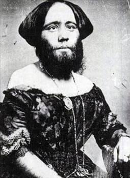 JOSEPHINE BOISDECHENE Joséphine 25 Mart 1831 yılında İsviçre'de doğdu. Doğduğunda kalın ve koyu renkli tüyleri vardı. Doktor bu tüylerin zamanla döküleceğini söylese de, aksine tüyleri daha çok uzayıp sertleşti. Ailesi tedavi için Joséphine'nin 8 yaşına gelmesini bekledi. 8 yaşına geldiğinde sakalları iyice uzamıştı. Doktorlar bir tedavi bulamadı ve Joséphine'in sakalları öylece kaldı. Annesi öldükten sonra babası Joséphine'e gelen teklifleri değerlendirdi ve 1849 yılında Joséphine bir şovmen ile çalışmaya başladı. 18 yaşına geldiğinde evlendi ve 1851 yılında bir kız çocuğu dünyaya getirdi. Bebeği annesi gibi tüylü değildi. Kızı sadece 11 ay yaşayabildi ve kızı öldükten 2 ay sonra Albert isimli bir oğlu oldu. Albert annesi gibi tüylü bir bebekti ve bu şovmenlerin ilgisini çekti. Bir müzede birlikte çalıştılar. Joséphine 1875 yılında öldü.