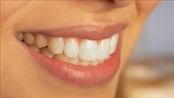 <p><strong><span style="color: #0000ff;">4- YARDIM ALIN</span></strong></p>
<p>Estetik Diş Hekimi Çağdaş Kışlaoğlu, dişlerinizi kendinizin de beyazlatabileceğinizi söylüyor. Ev tipi diş beyazlatmada, kişiye özel sadece dişleri kaplayan bir plak hazırlanıyor. İçine diş beyazlatma ürünü sıkılarak ortalama 10 gün boyunca takılıyor.</p>