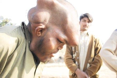 David Lynch 'Fil Adam' filminde onların dramını en iyi şekilde anlatmıştı. Son fil adam vakası Pakistan'ta yaşanıyor. Çaresiz adam yaşamak için gerekli yiyeceği korkunç görüntüsünü kullanarak kazanıyor