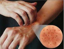 <p><br> Suya Alerjik Olunur Mu?<p><br>
Hayır. Bir Maddeye Karşı Alerji Bağışıklık Sisteminin Bu Maddeye Antikorlarıyla Saldırmasıyla Ortaya Çıkar. Ancak Suya Etki Eden Bir Antikor Bulunmuyor.