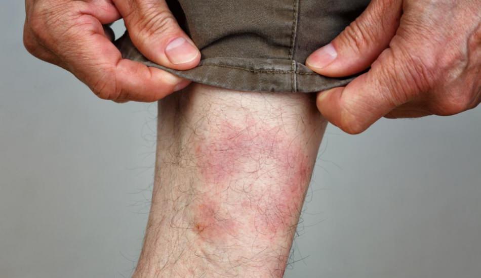 Lyme hastalığı nasıl ortaya çıkar? Lyme belirtileri nelerdir? Lyme